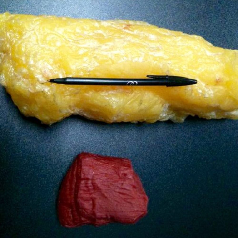 Λίπος Μύς | Λάμπρος Βακιάρος